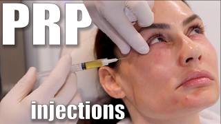 PRP Injections to Face and Neck Blood Facial [upl. by Pittel]