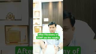 Result after Fibrotomy with Laser excellent response [upl. by Furie]