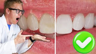 Dentist Reveals The BEST Teeth Whitening Results with Research Overnight Carbamide Peroxide Gel Kit [upl. by Lilith400]