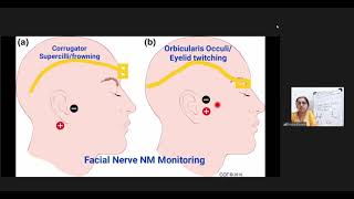 Neuromuscular Monitoring Part4 [upl. by Enitsirt]