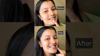 I Tried This Teeth Whitening Solution Under ₹500 [upl. by Chenay]