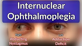 Internuclear Ophthalmoplegia  Left INO Case example explained [upl. by Lyreb790]