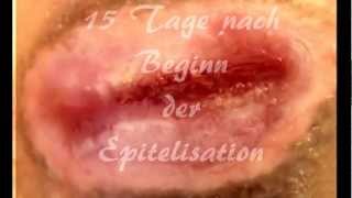 Wundheilung mit VAC Therapiesystem der Firma KCIwmv [upl. by Colette]