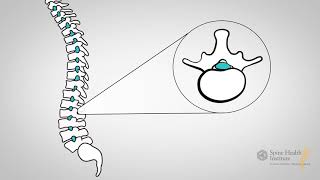 What Is Lumbar Stenosis [upl. by Lienaj]