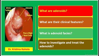 Adenoids Adenoid facies  Dr Krishna Koirala  Dr Krishnas ENT Lectures  Nepal ENT [upl. by Atwater]