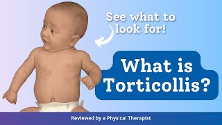 What is Torticollis [upl. by Elwyn629]