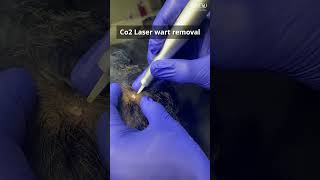 Wart Co2 laser removal on the Scalp Benefits and Considerations [upl. by Nelly]