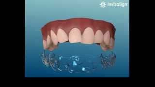 Invisalign système daligners invisibles transparents et amovibles [upl. by Hayes]