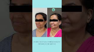 High smas lift 45 days postop No amount of filler or nonsurgical procedures can offer such result [upl. by Annie334]