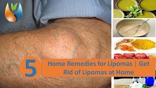 5 Home Remedies for Lipomas  Get Rid of Lipomas at Home [upl. by Oruntha807]