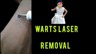 warts Laser Removal 9747588080 [upl. by Tjader178]