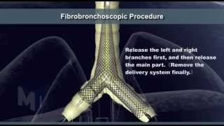 Tracheal Stent [upl. by Damahom]