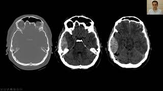 Hematoma Epidural tudo o que você precisa saber na imagem [upl. by Accire]