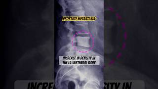 Prostate Metastasis 🩻 shorts doctor radiology [upl. by Marshall]