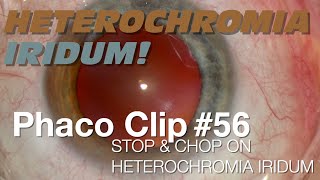 Phaco Clip 56  Stop amp Chop on Heterochromia Iridum [upl. by Leur]