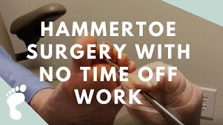 Hammertoe Surgery With No Time Off Work [upl. by Clarhe]