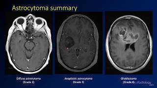 Imaging brain tumors  2  Astrocytomas [upl. by Brader]