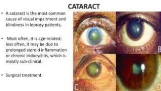 Effects of Leprosy on the Eyes [upl. by Sidwel16]