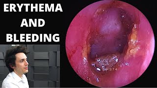 Erythema And Bleeding In The Ear Canal During Wax Extraction [upl. by Esenej]