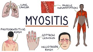 Understanding Myositis Polymyositis and Dermatomyositis [upl. by Tilly]