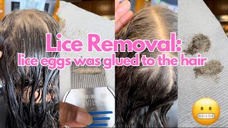 Nits was glued to the hair l 2 hr lice removal l small business explore hair lice [upl. by Naret832]