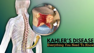 Kahlers Disease Causes Signs and Symptoms Diagnosis and Treatment [upl. by Annadal]