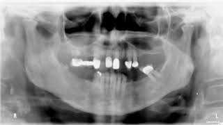 Quiz bilateral soft tissue radiopacities [upl. by Stanway]