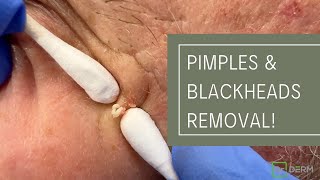 Pimples and Blackheads Removal  Dr Derm [upl. by Atelahs]