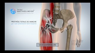 PROTHÈSE TOTALE DE HANCHE PAR VOIE ANTÉRIEURE MINIINVASIVE  DR MATTHIEU MEYER [upl. by Aramoiz]