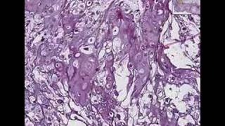 Histopathology BoneChondroma [upl. by Wilkie]