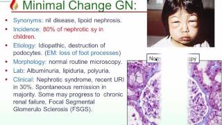 Shashi Pathology Lectures Glomerulonephritis [upl. by Chloette330]