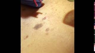 Treatment of Seborrheic Keratosis [upl. by Ahsekram69]