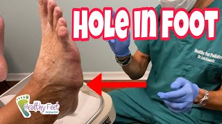 ANOTHER DIABETIC FOOT CATASTROPHE AND BONUS DIABETIC FOOT CARE TIPS [upl. by Jannelle396]