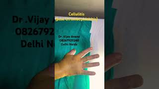 cellulitis post iv Thrombophlebitis surgery neet yt shorts cellulitis ssi skincare [upl. by Ricardo397]