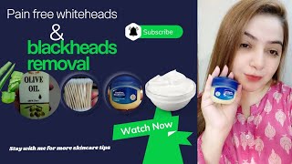 Remove your blackheads and whiteheads at home without pain 👍 [upl. by Yesima86]