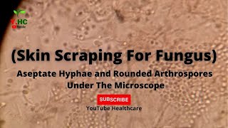 Aseptate Hyphae And Rounded Arthrospores  Skin Scrap For Fungus  Microscopy by YouTube Healthcare [upl. by Hizar]