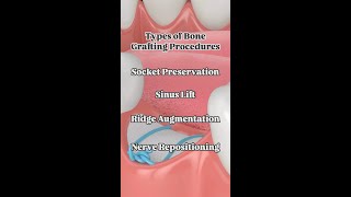 Types of Bone Grafting Procedures [upl. by Weismann]