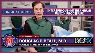 Interspinous Interlaminar Fusion Procedure Douglas P Beall MD [upl. by Sukramaj659]