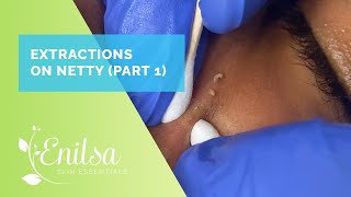 Blackheads and more blackheads Nettys First Treatment [upl. by Ileana]