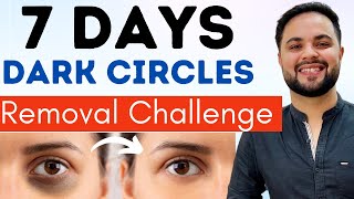 7 Days Dark Circles Removal Challenge  Permanent Treatment [upl. by Ytissac797]