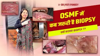 OSMF में कब जरुरी है BIOPSY क्यों करवाए BIOPSY [upl. by Jac450]