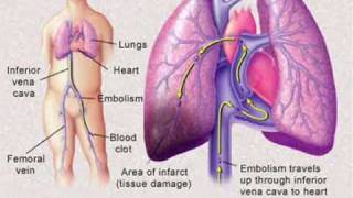 Pulmonary Embolism [upl. by Kidder542]