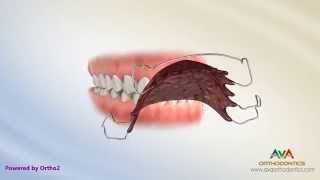 Orthodontic Retainers Hawley Clear and Permanent [upl. by Atiuqad]