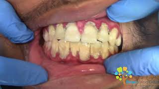 Dental Cleaning to remove heavy tartar🦷 【Young Male first cleaning】 [upl. by Claiborn637]