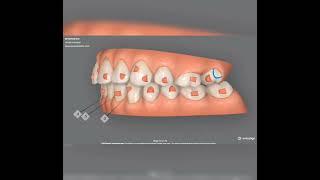 Smile correction with Invisalign at EIRA DENTAL [upl. by Sairahcaz]