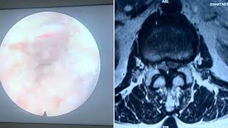 Interlaminar Endoscopic Decompression Multilevel Lumbar canal stenosis in old age [upl. by Eiffub892]