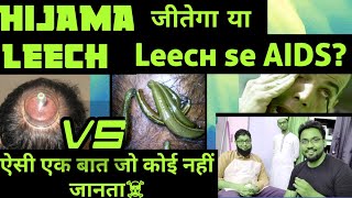 Hijama Therapy Vs Leech Therapy  कौन न है सबका बाप कौन है सबसे ज्यादा effective [upl. by Martino936]