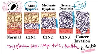 USMLE ACE Video 88 Human Papillomavirus HPV and Cervical Cancer Risk Factors [upl. by Ibbison]