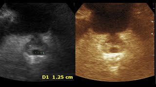 Enlarge prostate  Calcification of prostate  Utricle cyst [upl. by Mariana]