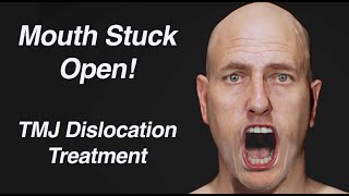 How to Reduce a TMJ Dislocation [upl. by Akimrej281]